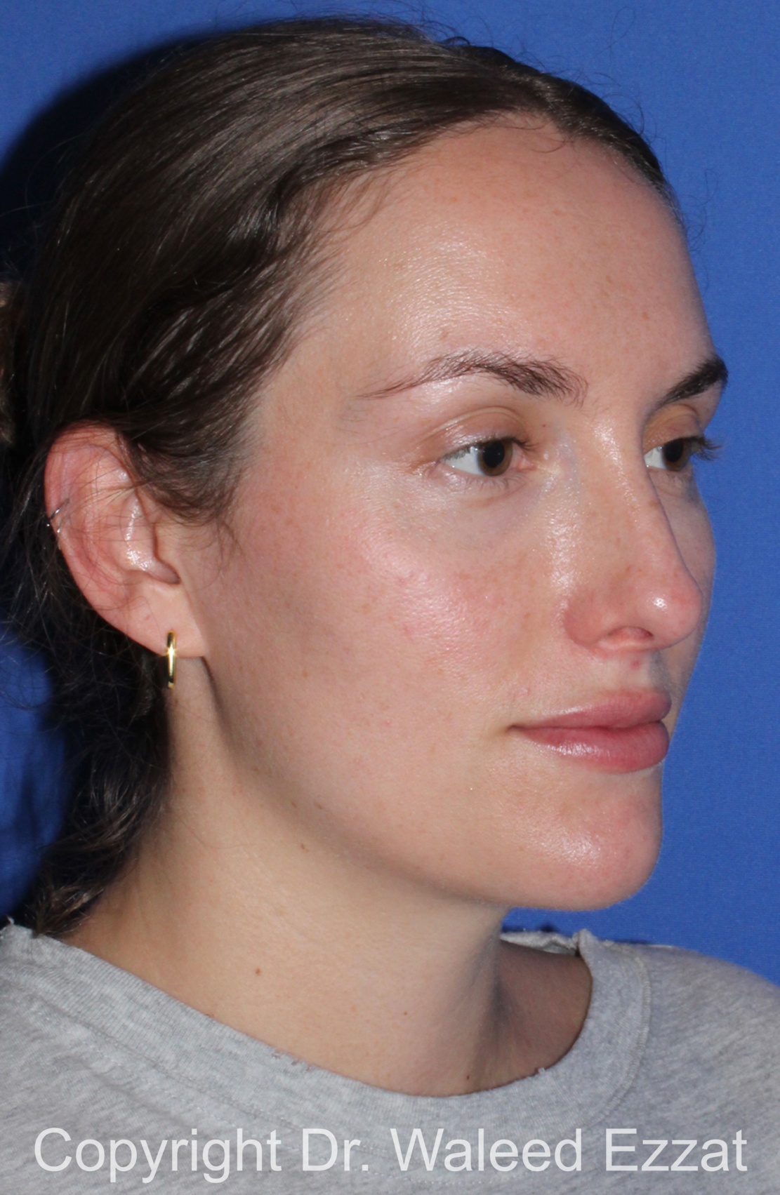 Caucasian/European Rhinoplasty Patient Photo - Case 336 - after view-1