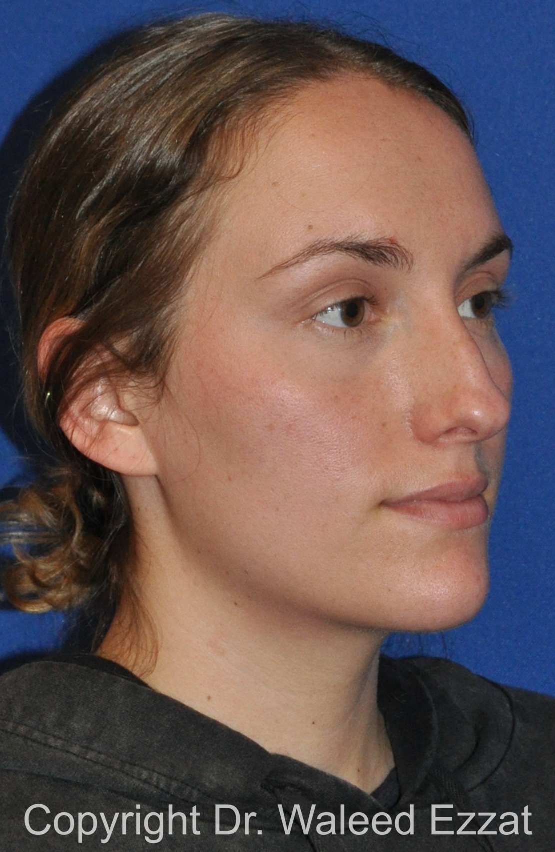 Caucasian/European Rhinoplasty Patient Photo - Case 336 - before view-1