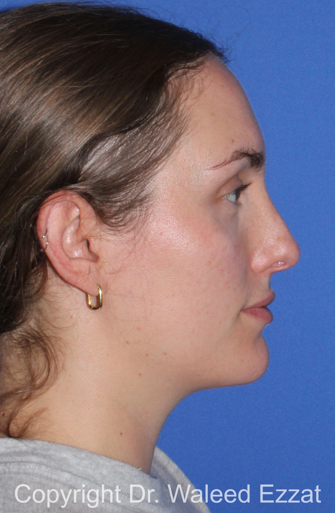 Caucasian/European Rhinoplasty Patient Photo - Case 336 - after view