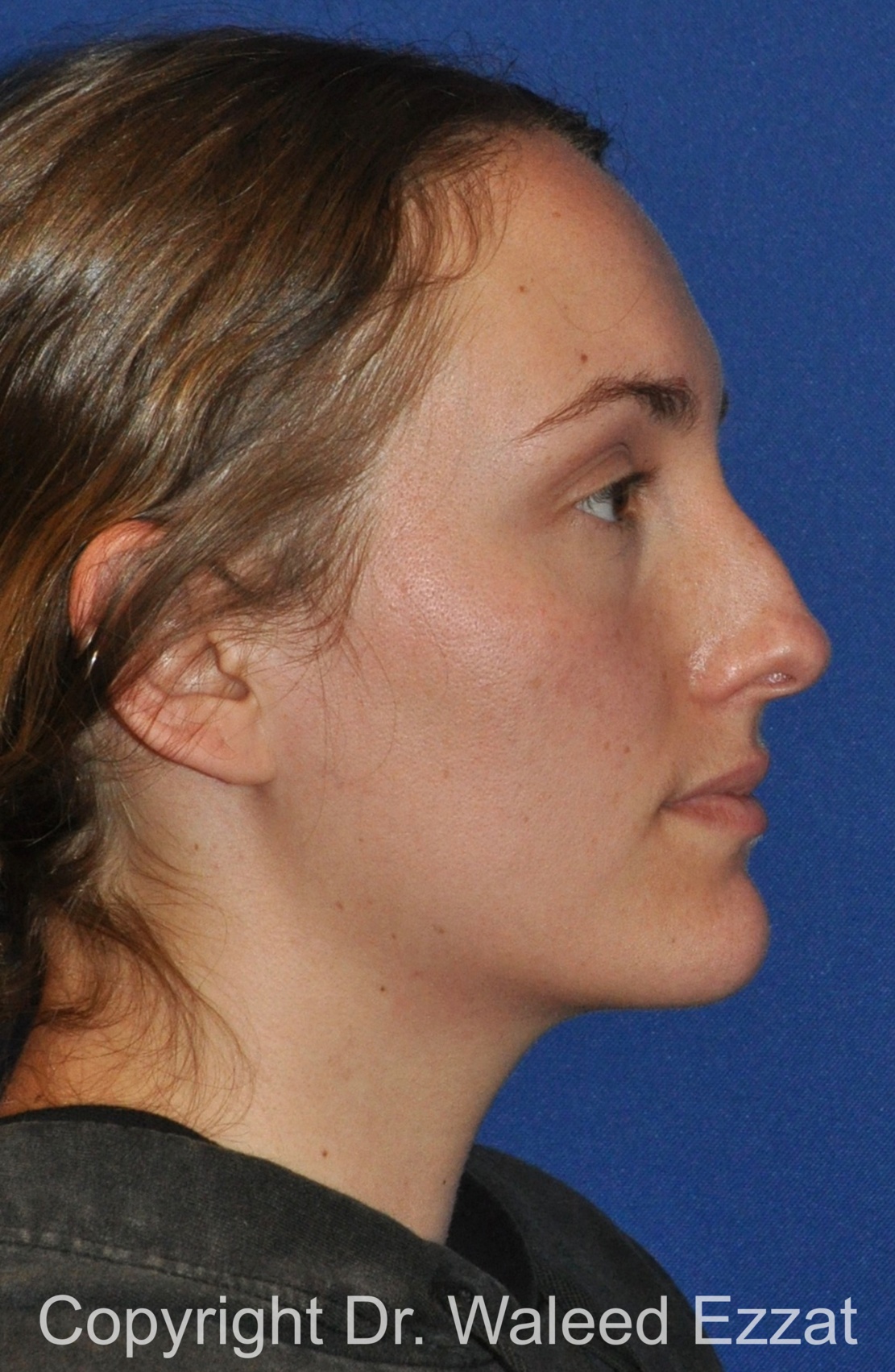 Caucasian/European Rhinoplasty Patient Photo - Case 336 - before view-