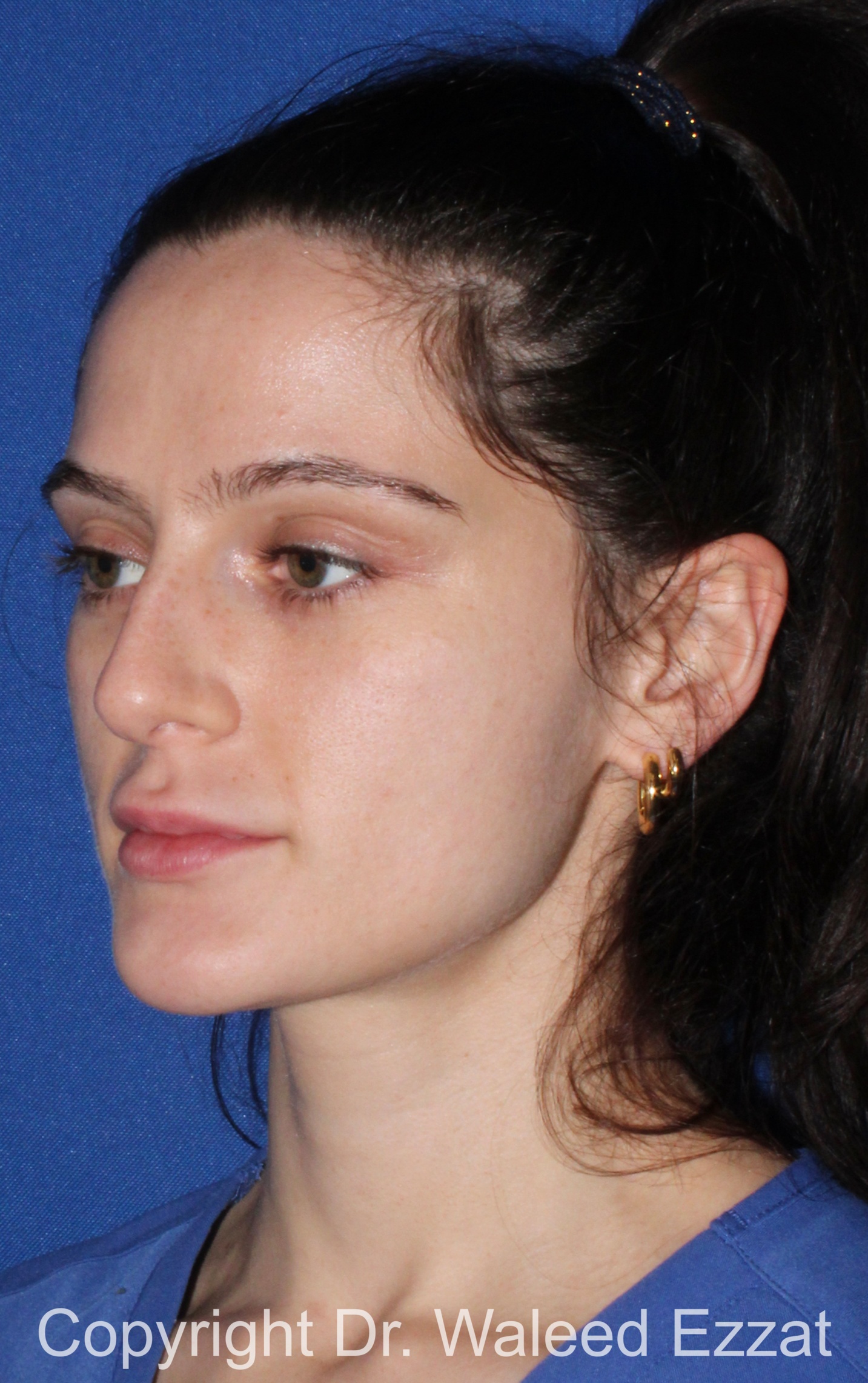 Caucasian/European Rhinoplasty Patient Photo - Case 337 - before view-1