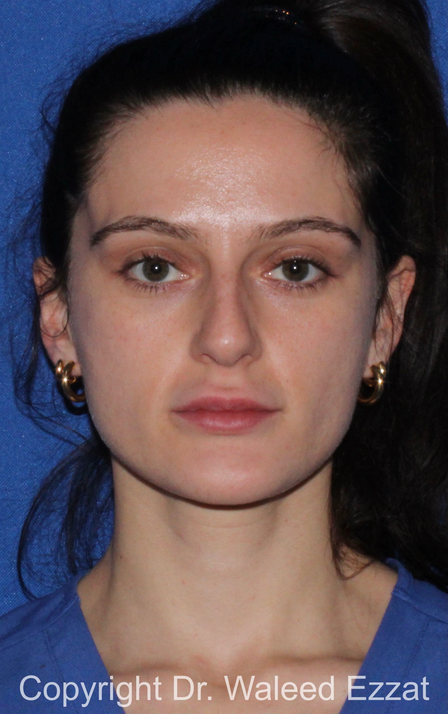 Caucasian/European Rhinoplasty Patient Photo - Case 337 - before view-2