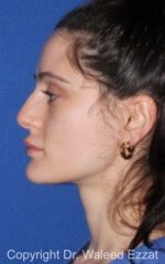 Caucasian/European Rhinoplasty - Case 337 - Before