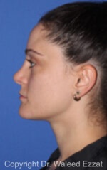Caucasian/European Rhinoplasty - Case 337 - After