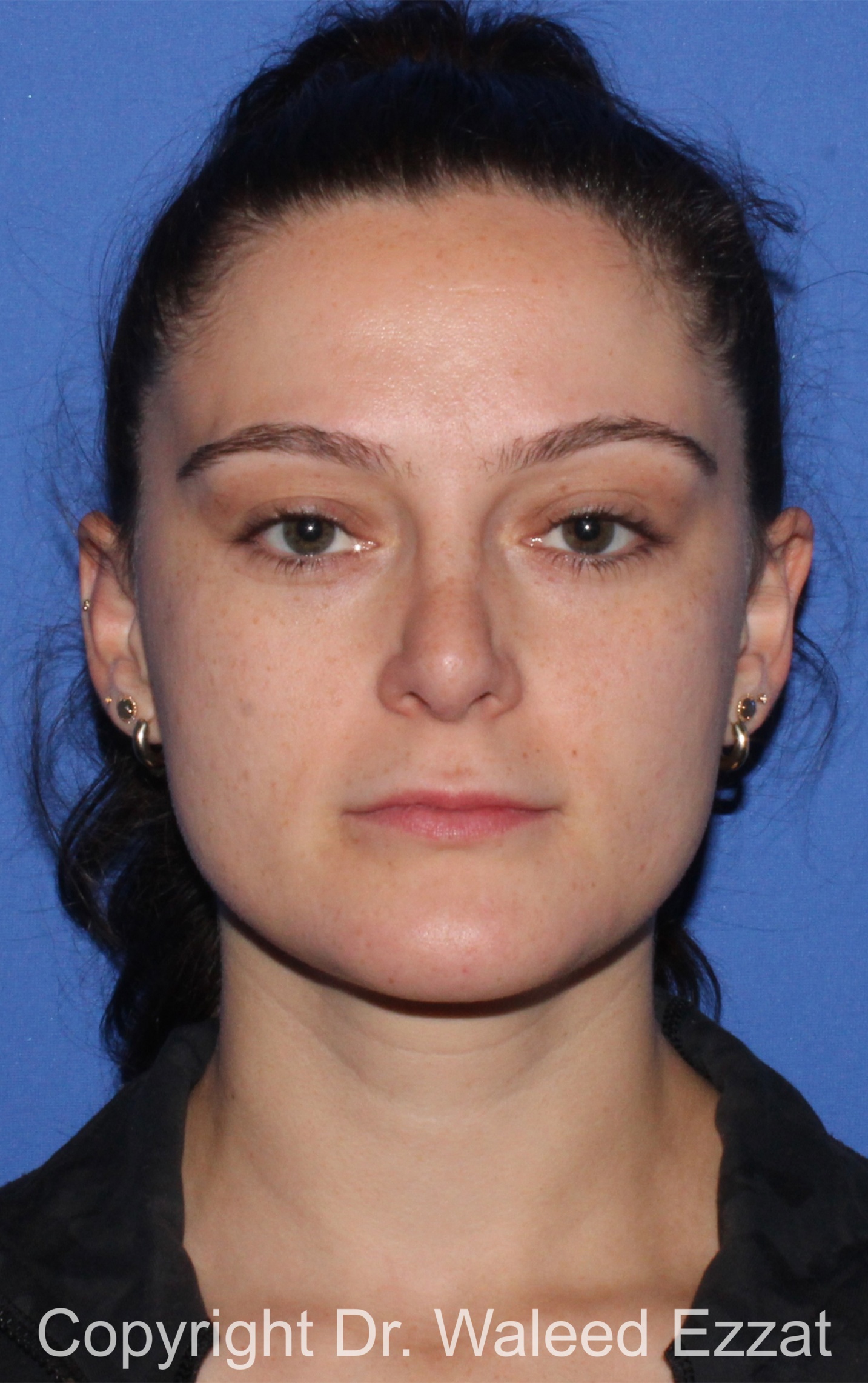 Caucasian/European Rhinoplasty Patient Photo - Case 337 - after view-2