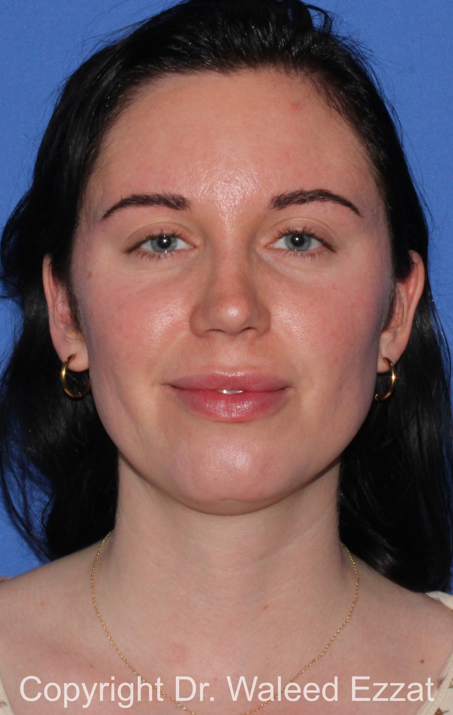 Caucasian/European Rhinoplasty Patient Photo - Case 338 - after view-2