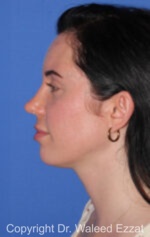 Caucasian/European Rhinoplasty - Case 338 - After