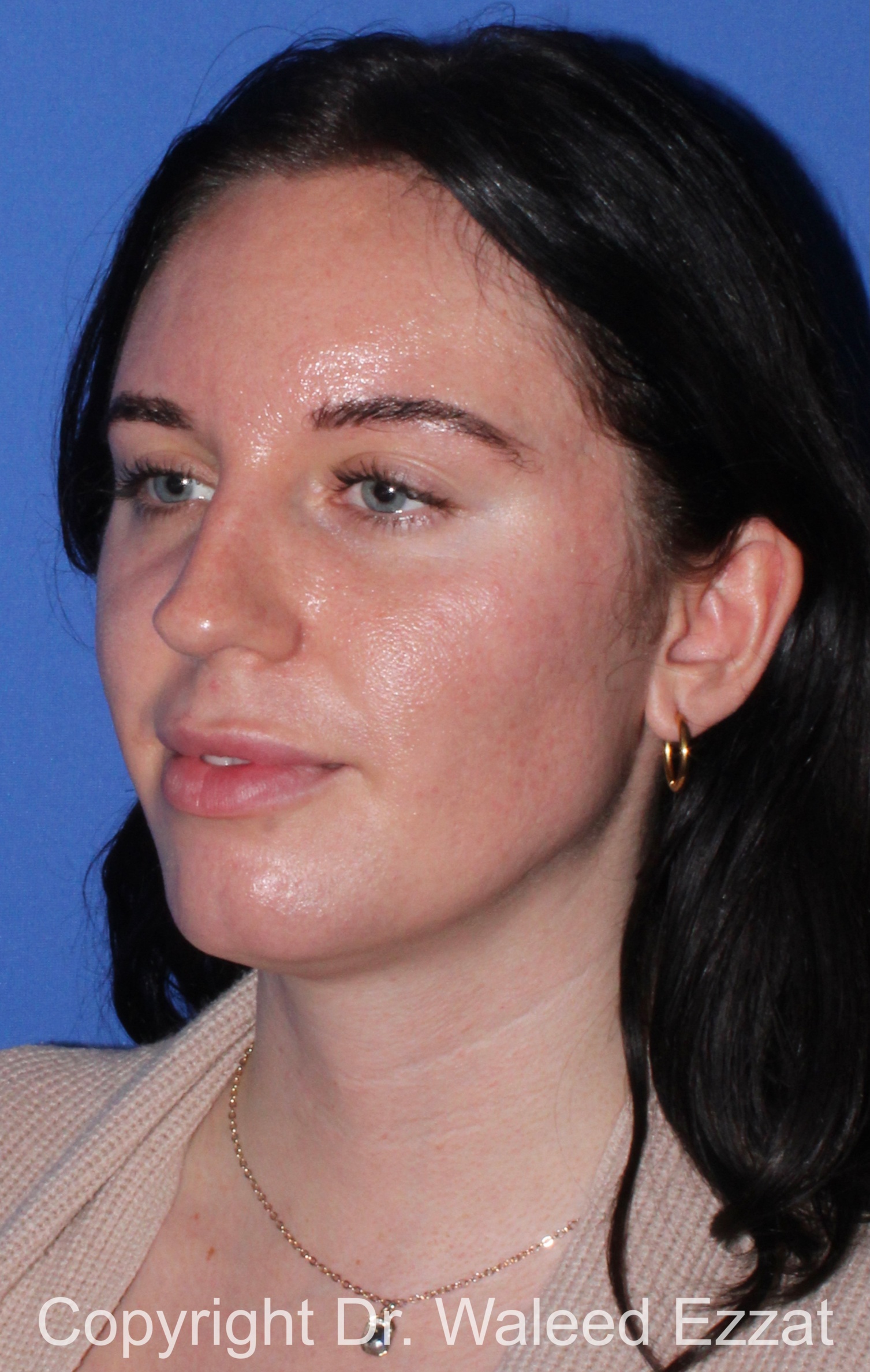 Caucasian/European Rhinoplasty Patient Photo - Case 338 - before view-1