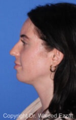 Caucasian/European Rhinoplasty - Case 338 - Before