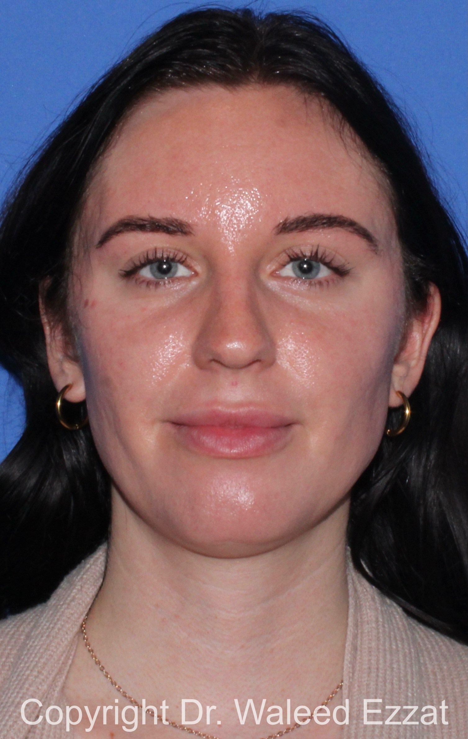 Caucasian/European Rhinoplasty Patient Photo - Case 338 - before view-2