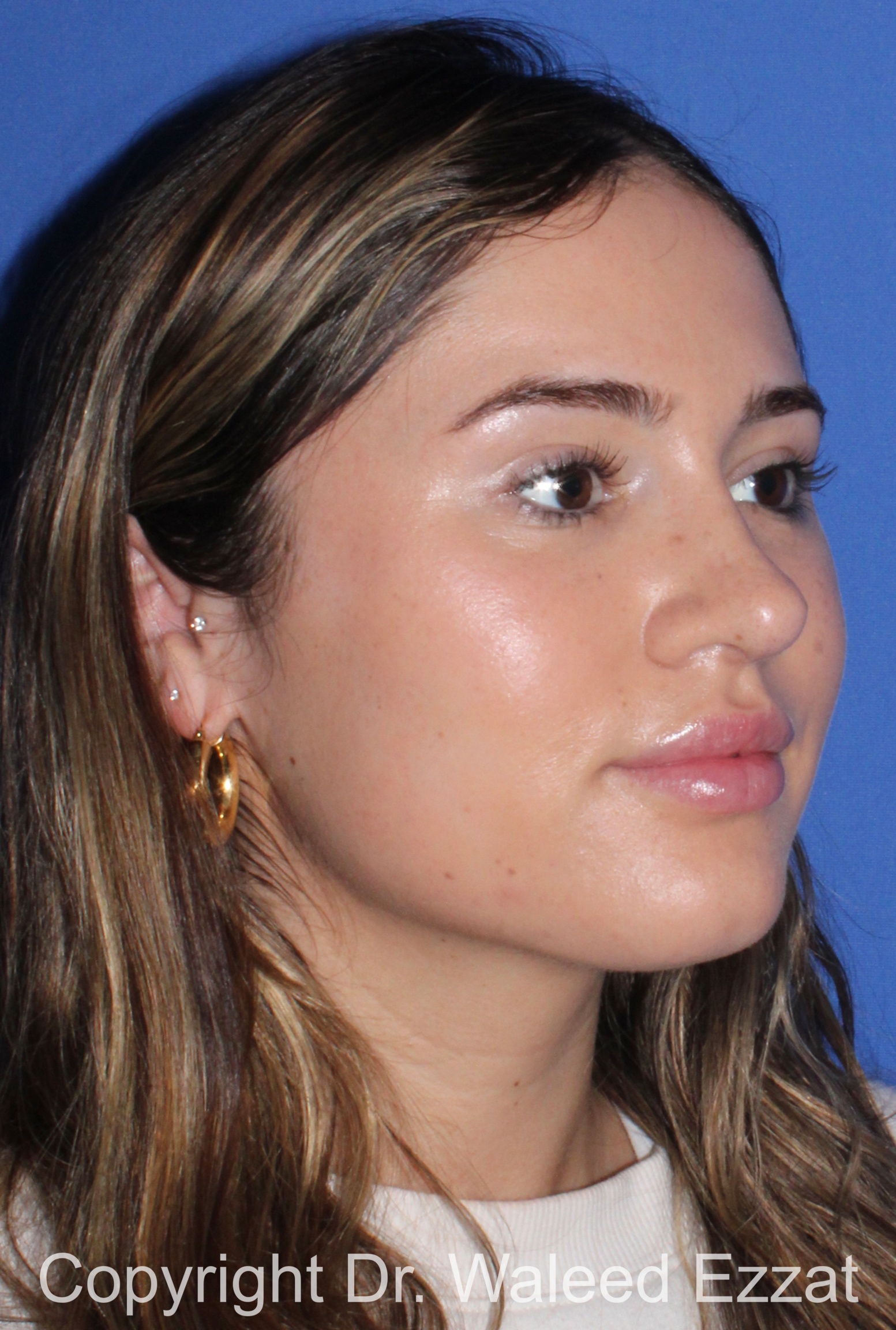 Rhinoplasty Patient Photo - Case 339 - after view-1