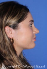 Caucasian/European Rhinoplasty - Case 339 - After