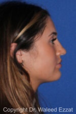 Caucasian/European Rhinoplasty - Case 339 - Before