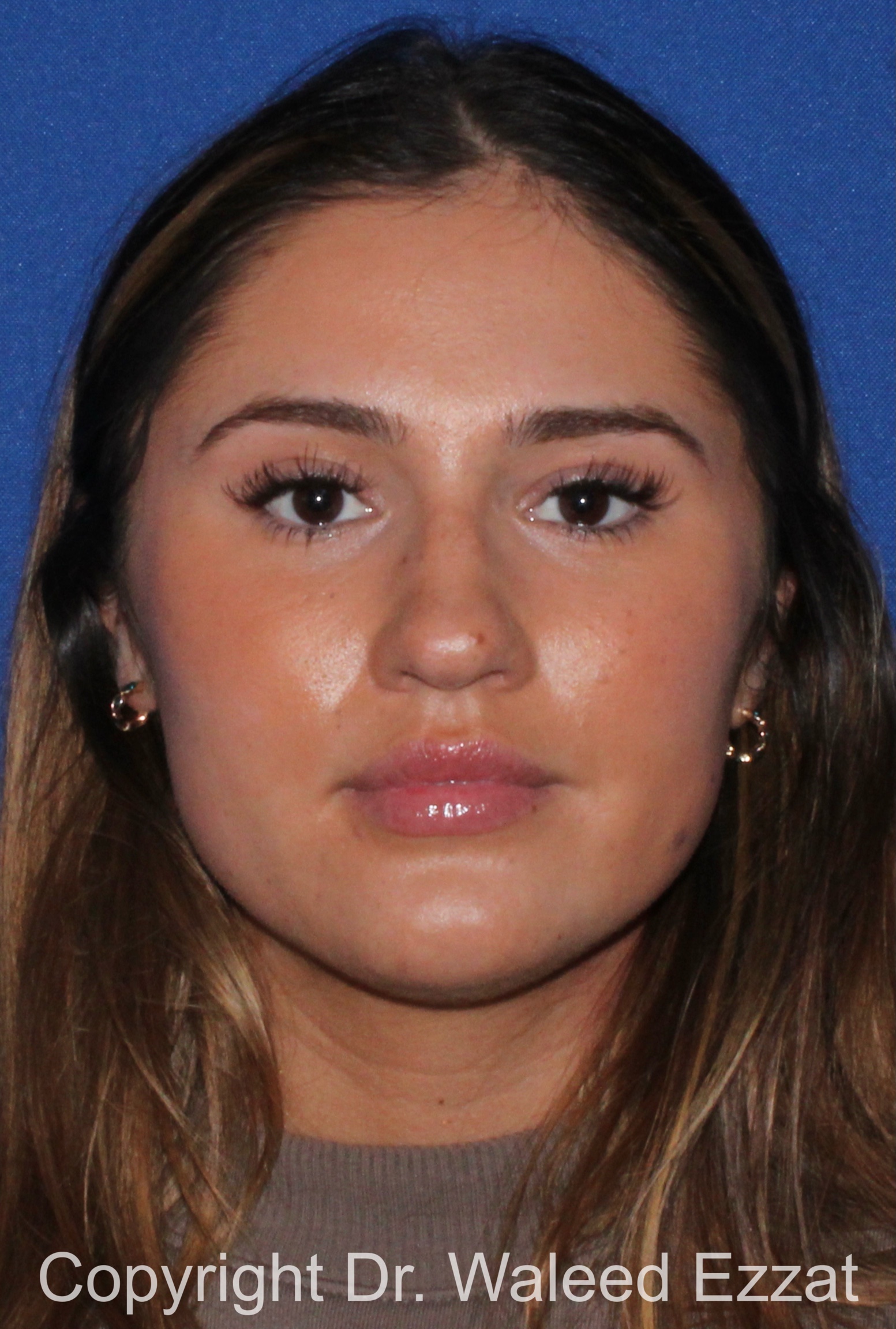 Rhinoplasty Patient Photo - Case 339 - before view-2