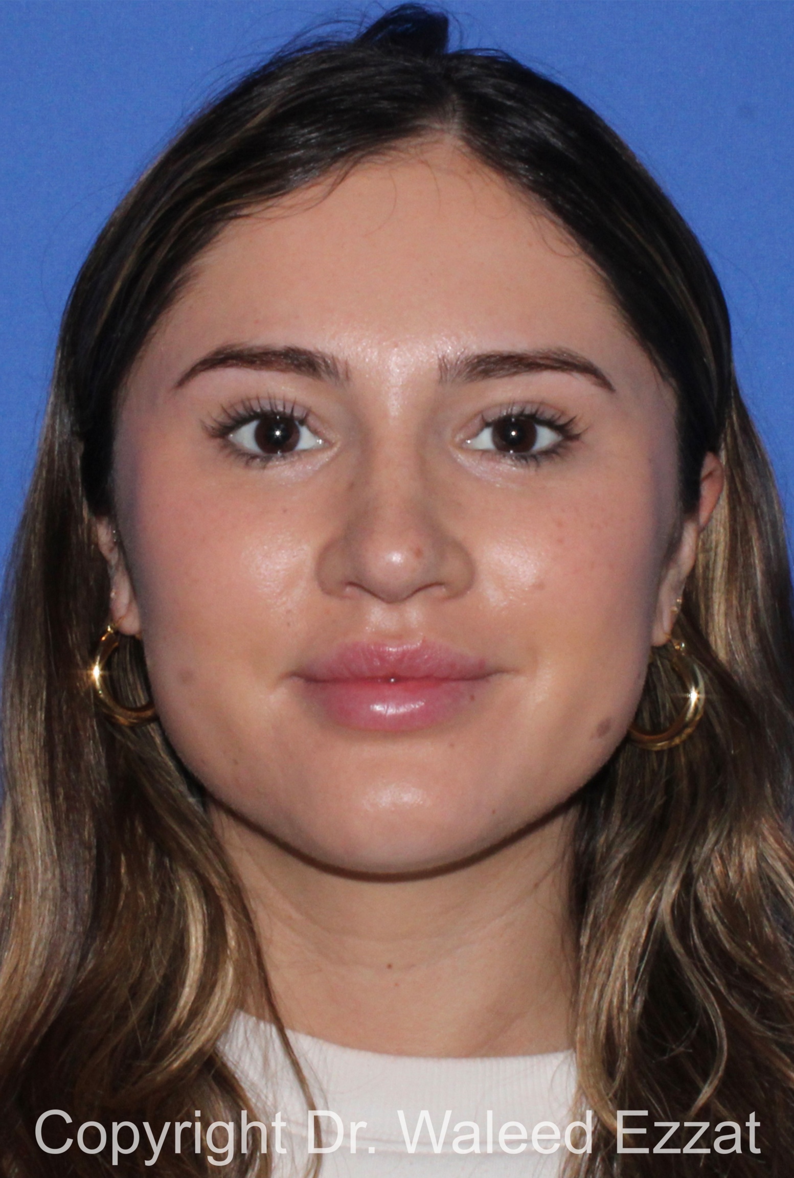 Rhinoplasty Patient Photo - Case 339 - after view-2