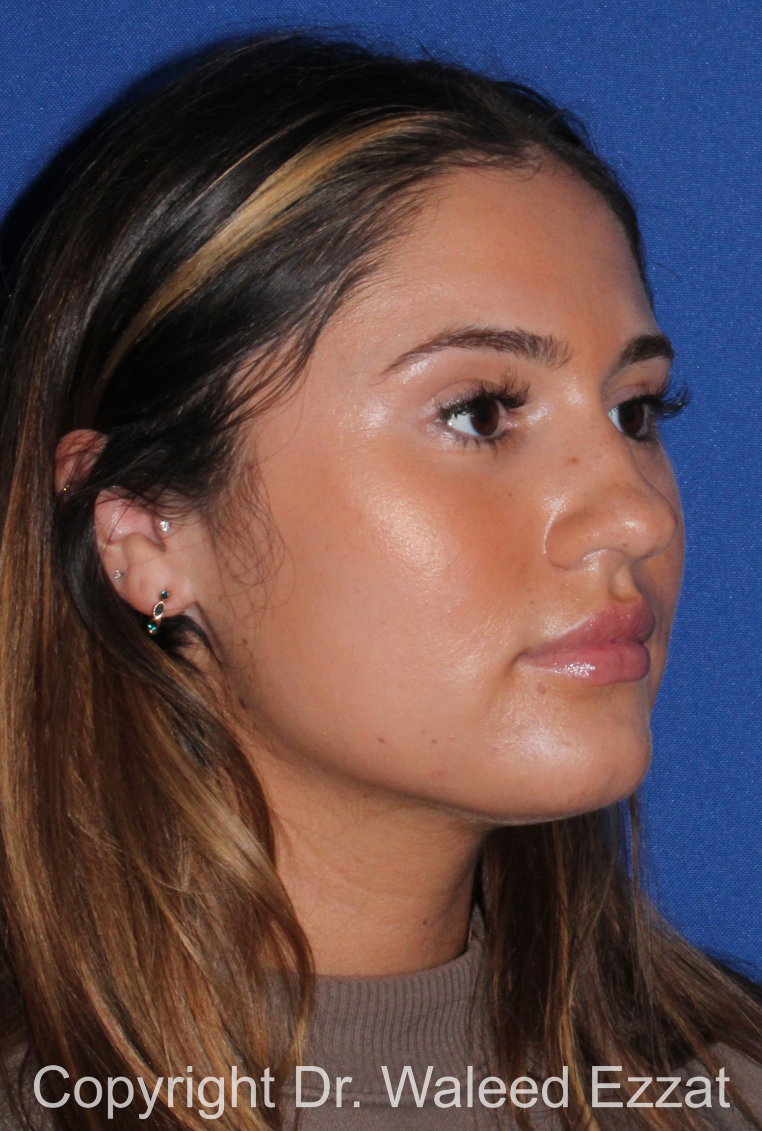 Rhinoplasty Patient Photo - Case 339 - before view-1