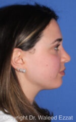 Caucasian/European Rhinoplasty - Case 343 - After