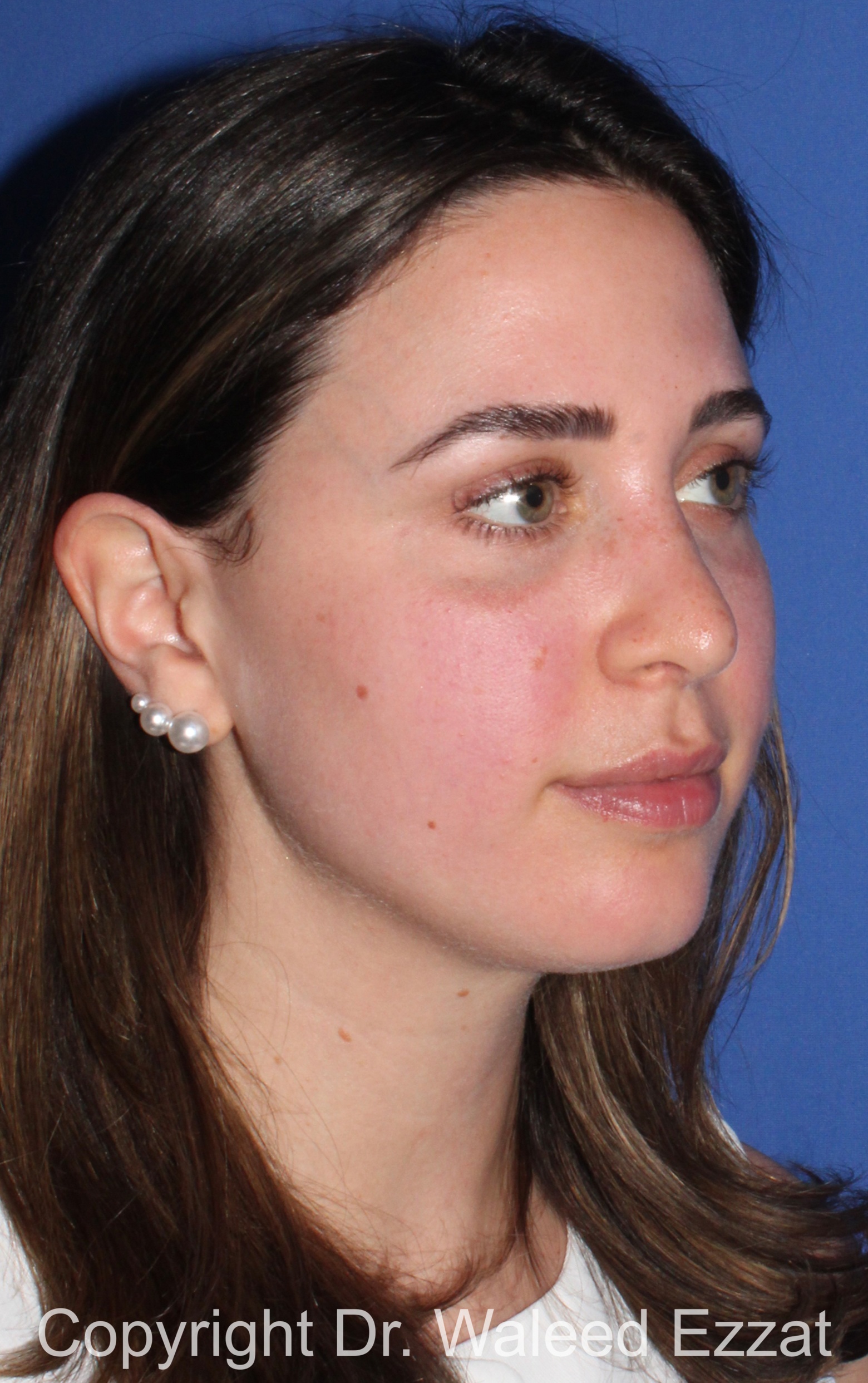 Rhinoplasty Patient Photo - Case 343 - after view-1