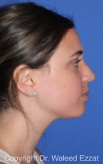 Caucasian/European Rhinoplasty - Case 343 - Before