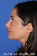 Caucasian/European Rhinoplasty - Case 344 - After