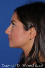 Caucasian/European Rhinoplasty - Case 344 - Before