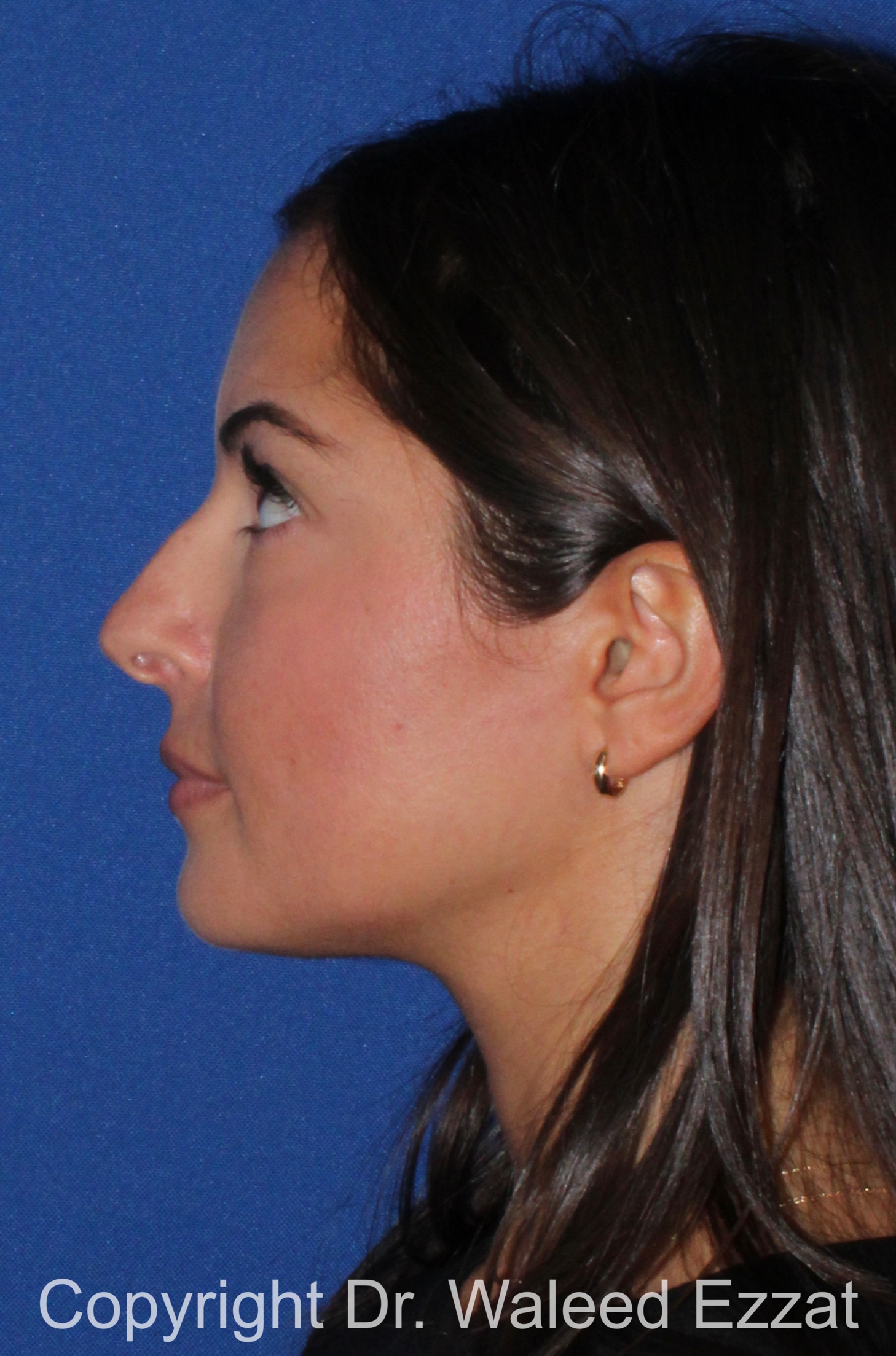 Caucasian/European Rhinoplasty Patient Photo - Case 344 - before view-