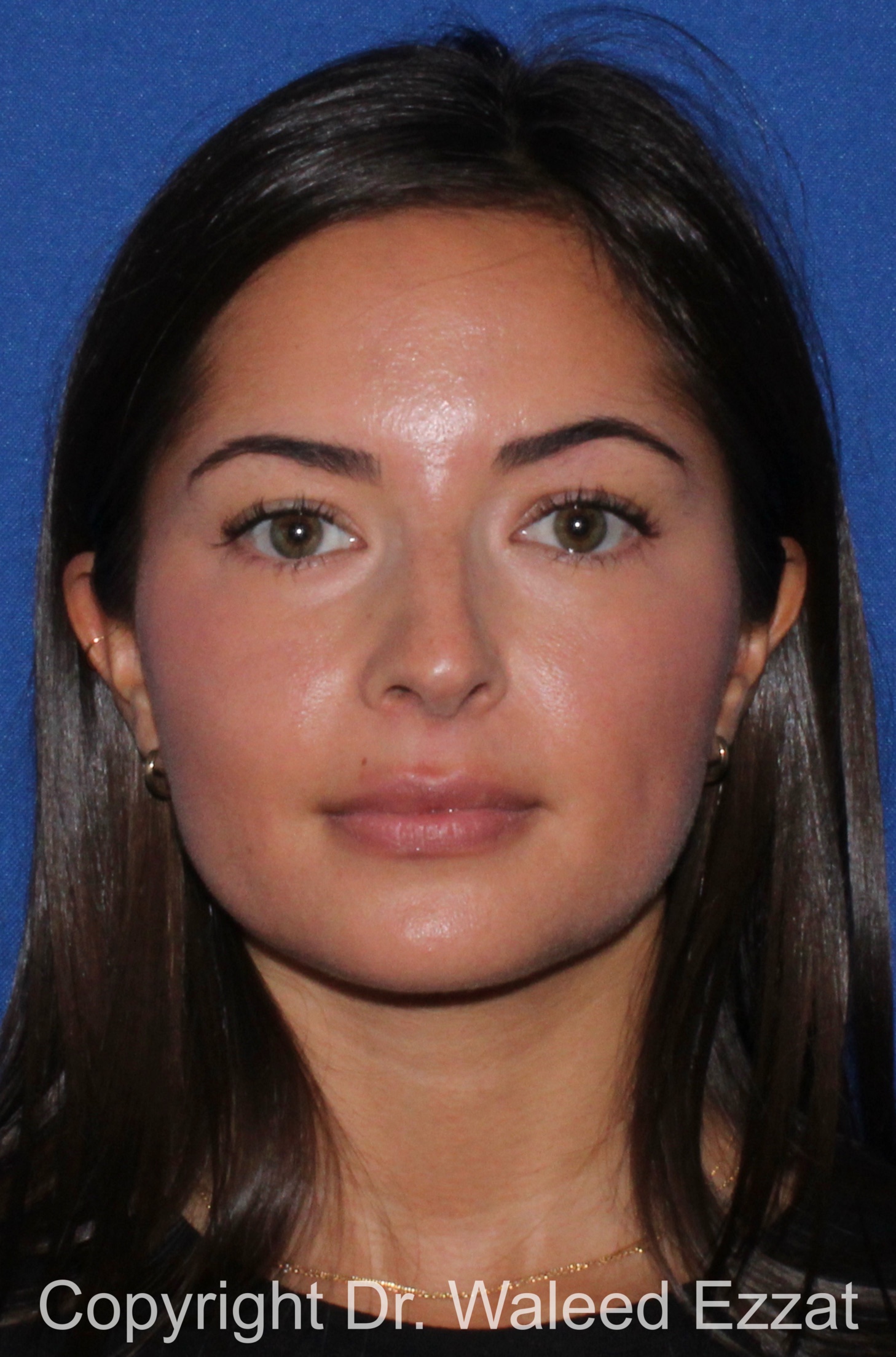 Caucasian/European Rhinoplasty Patient Photo - Case 344 - before view-2