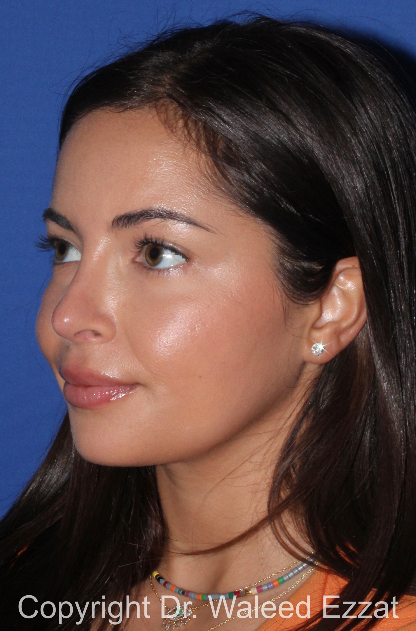 Caucasian/European Rhinoplasty Patient Photo - Case 344 - after view-1