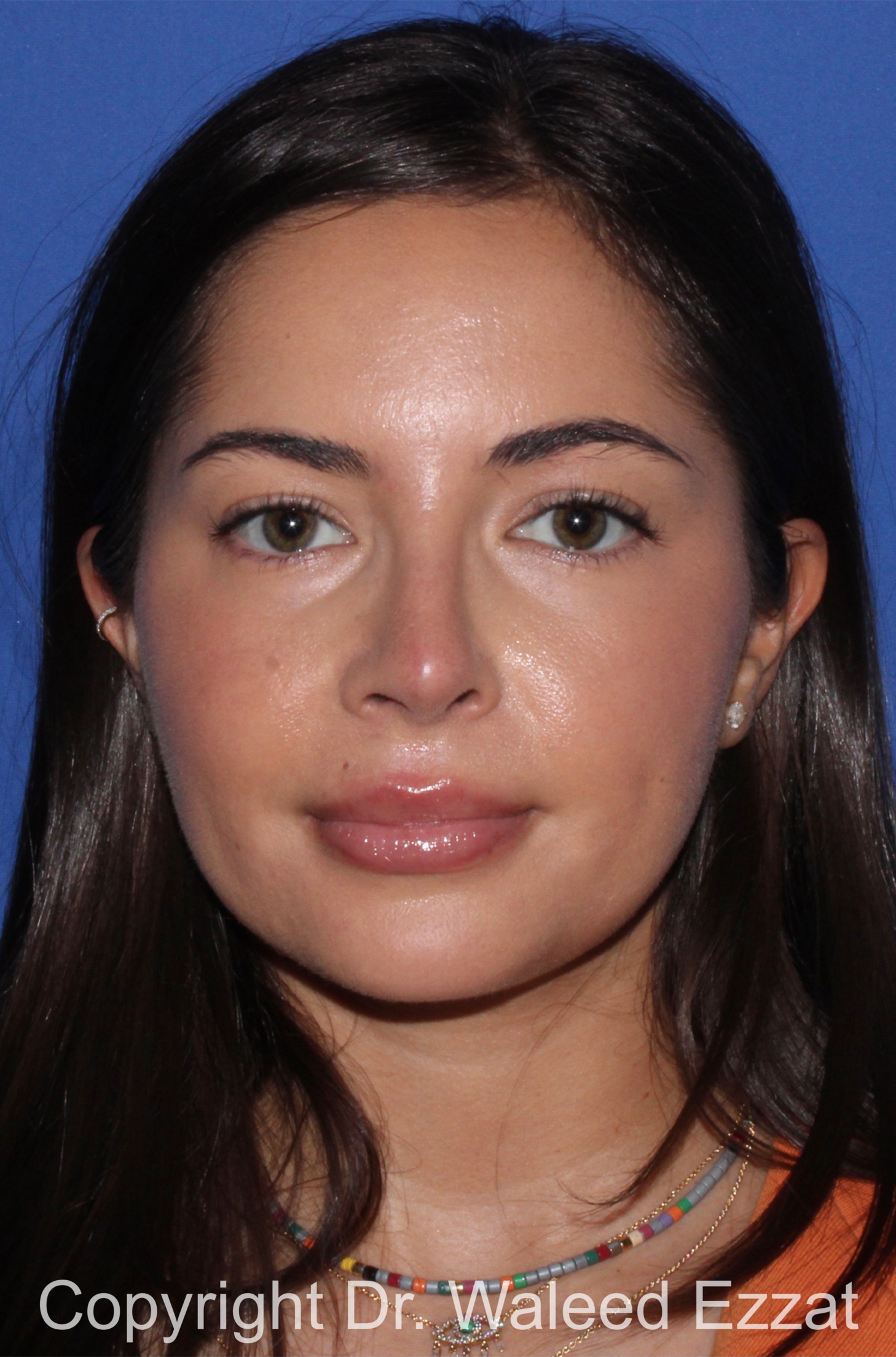 Caucasian/European Rhinoplasty Patient Photo - Case 344 - after view-2