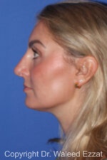 Caucasian/European Rhinoplasty - Case 345 - After