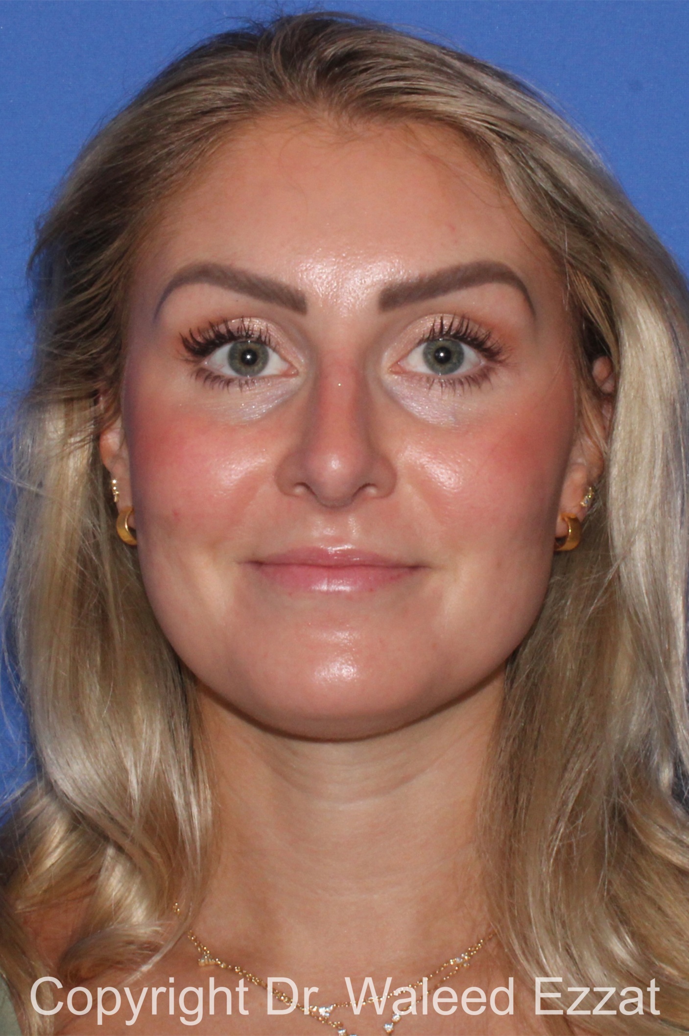 Rhinoplasty Patient Photo - Case 345 - after view-2