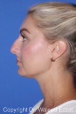 Caucasian/European Rhinoplasty - Case 345 - Before