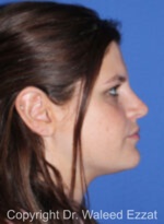 Caucasian/European Rhinoplasty - Case 346 - After