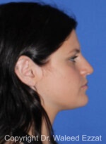Caucasian/European Rhinoplasty - Case 346 - Before