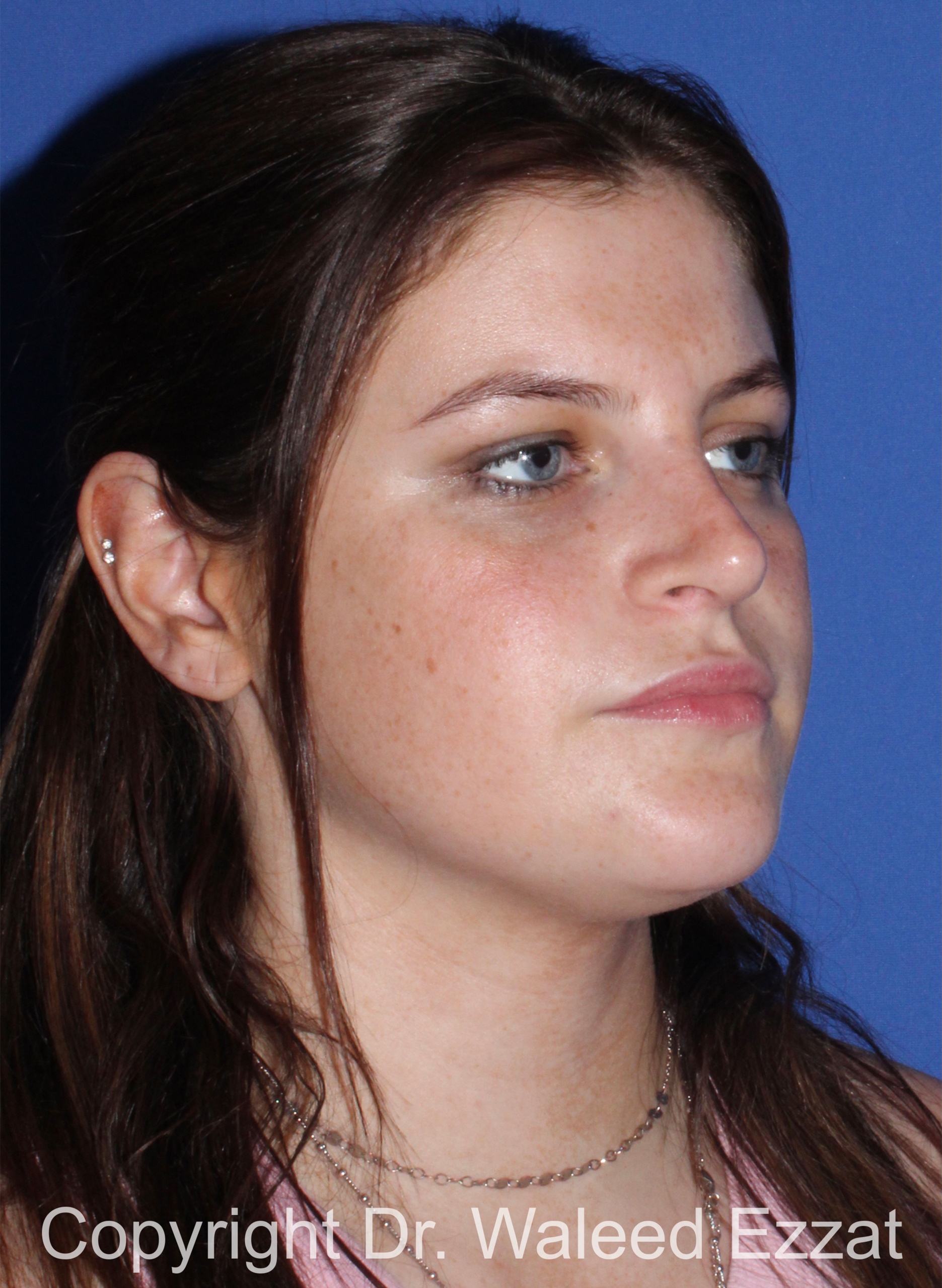 Caucasian/European Rhinoplasty Patient Photo - Case 346 - after view-1