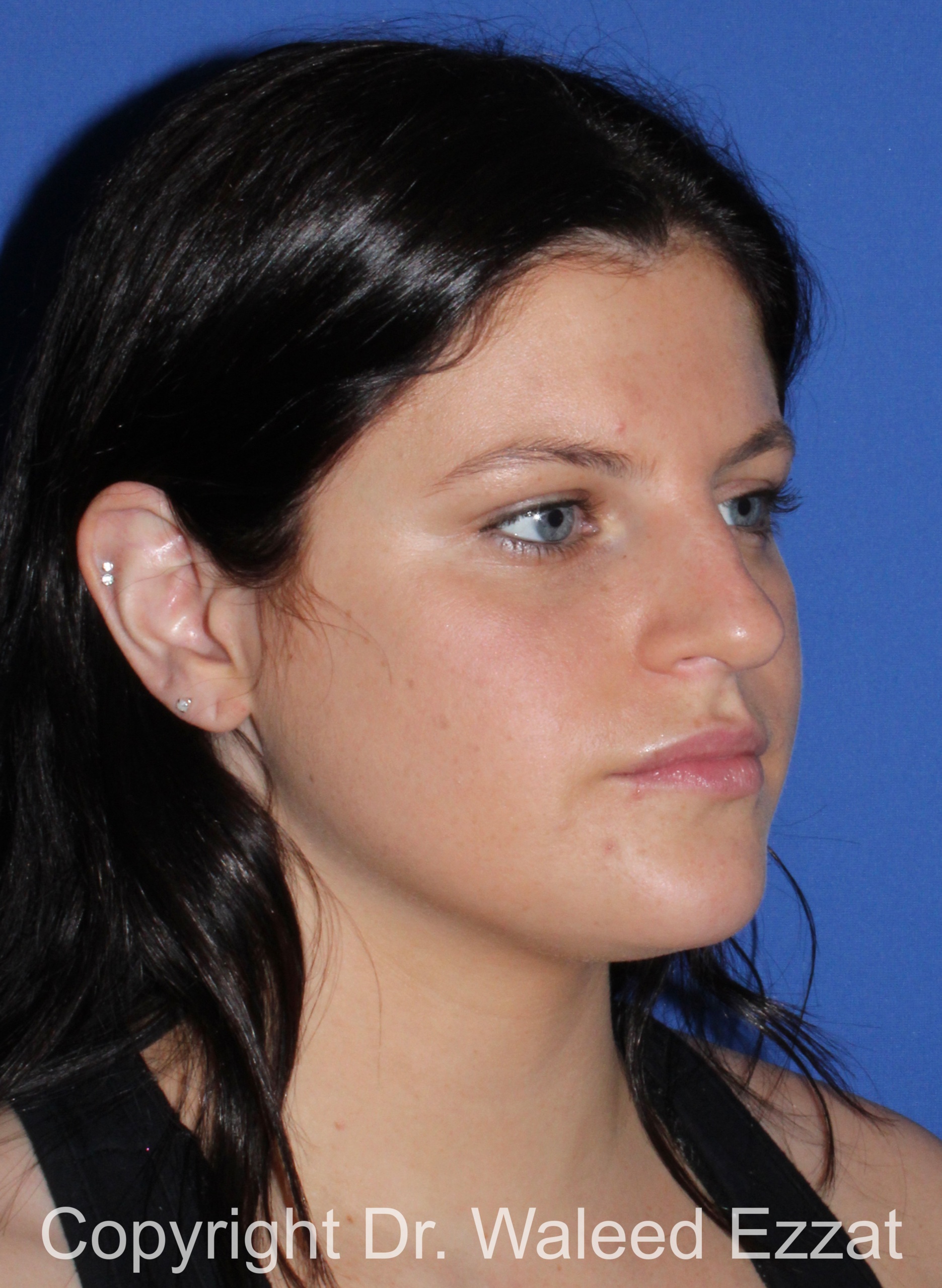 Caucasian/European Rhinoplasty Patient Photo - Case 346 - before view-1