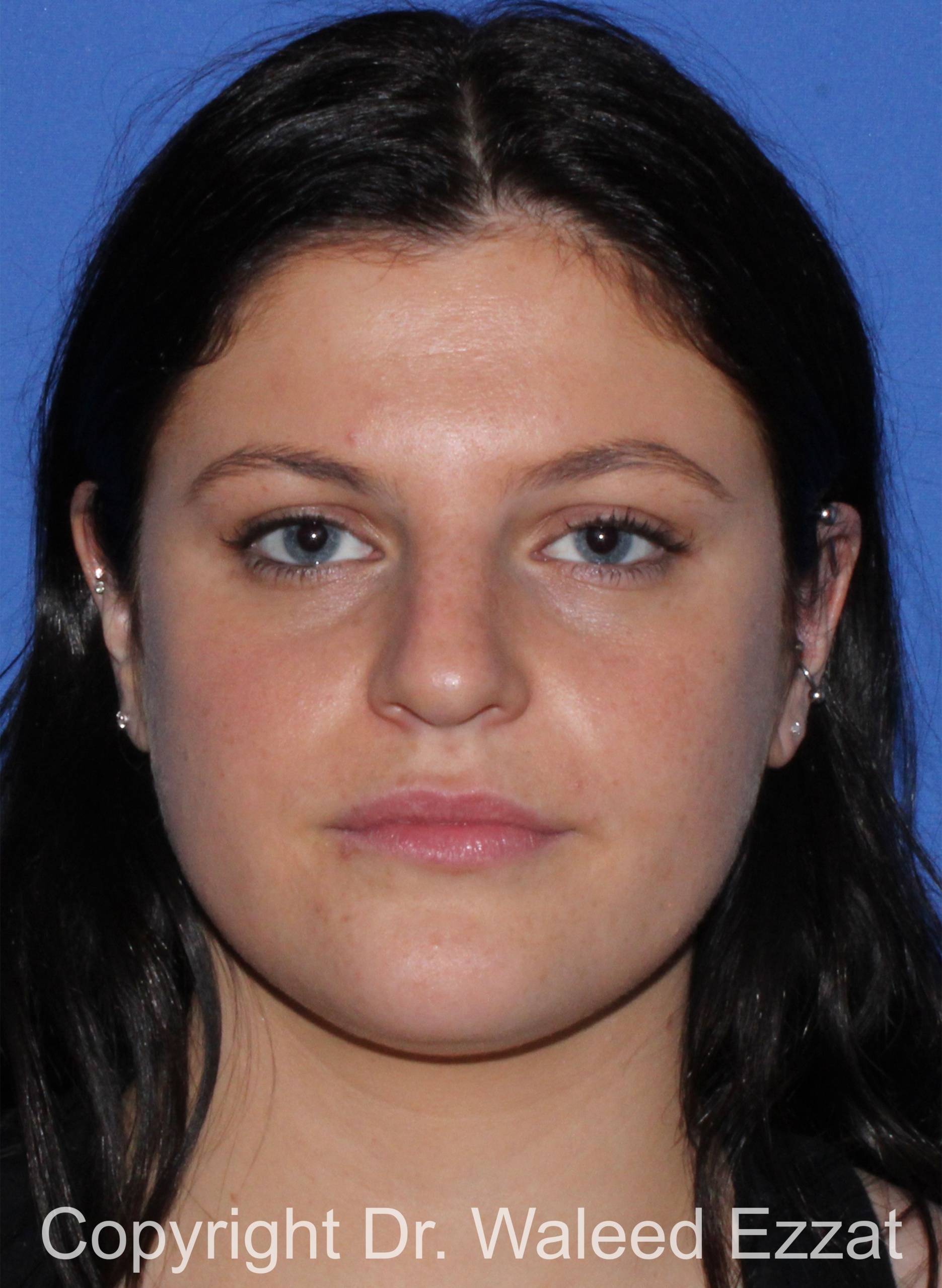 Caucasian/European Rhinoplasty Patient Photo - Case 346 - before view-2