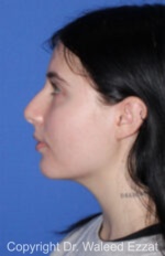 Caucasian/European Rhinoplasty - Case 347 - Before