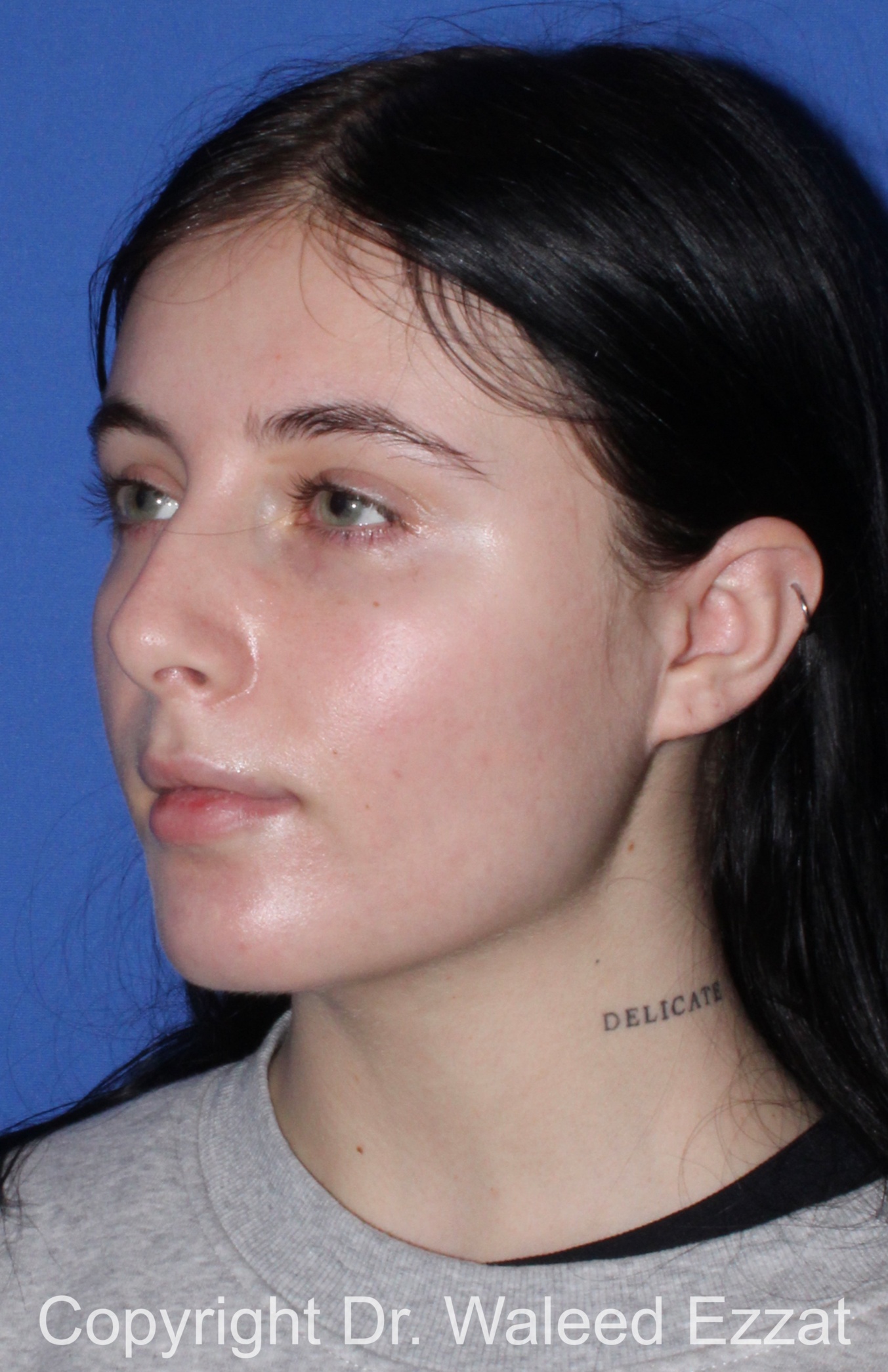 Caucasian/European Rhinoplasty Patient Photo - Case 347 - before view-1