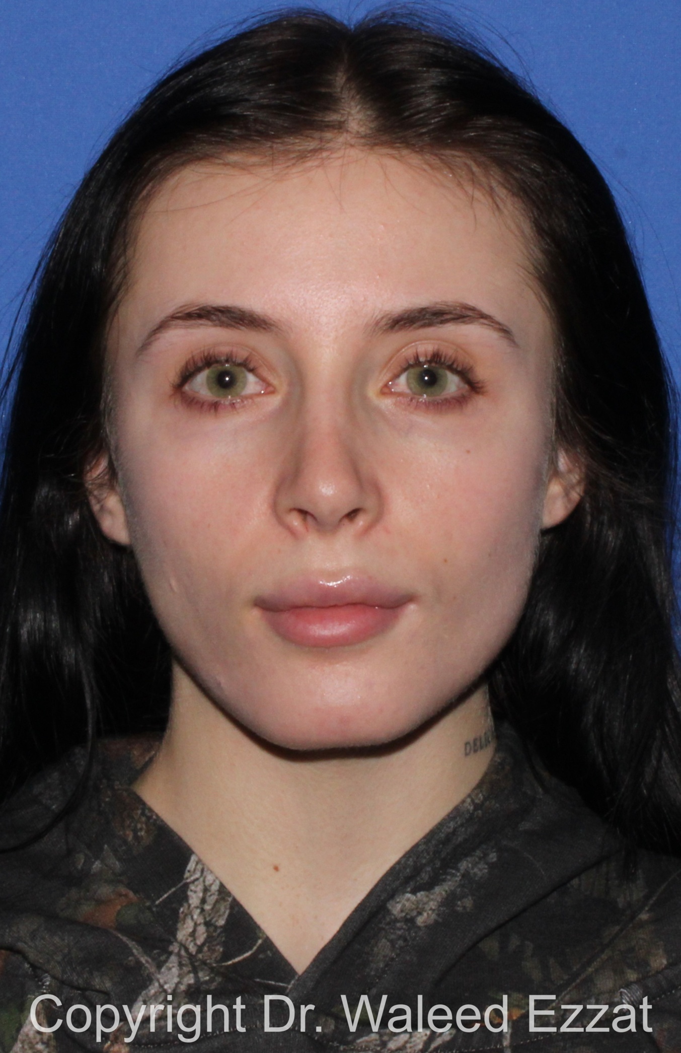 Caucasian/European Rhinoplasty Patient Photo - Case 347 - after view-2