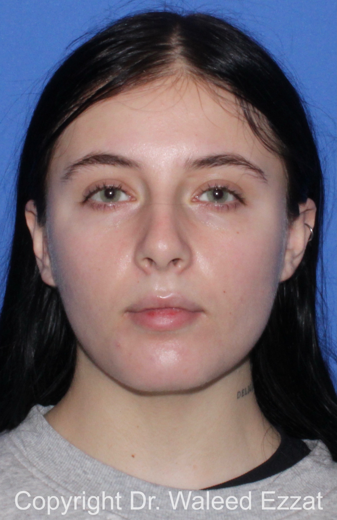 Caucasian/European Rhinoplasty Patient Photo - Case 347 - before view-2