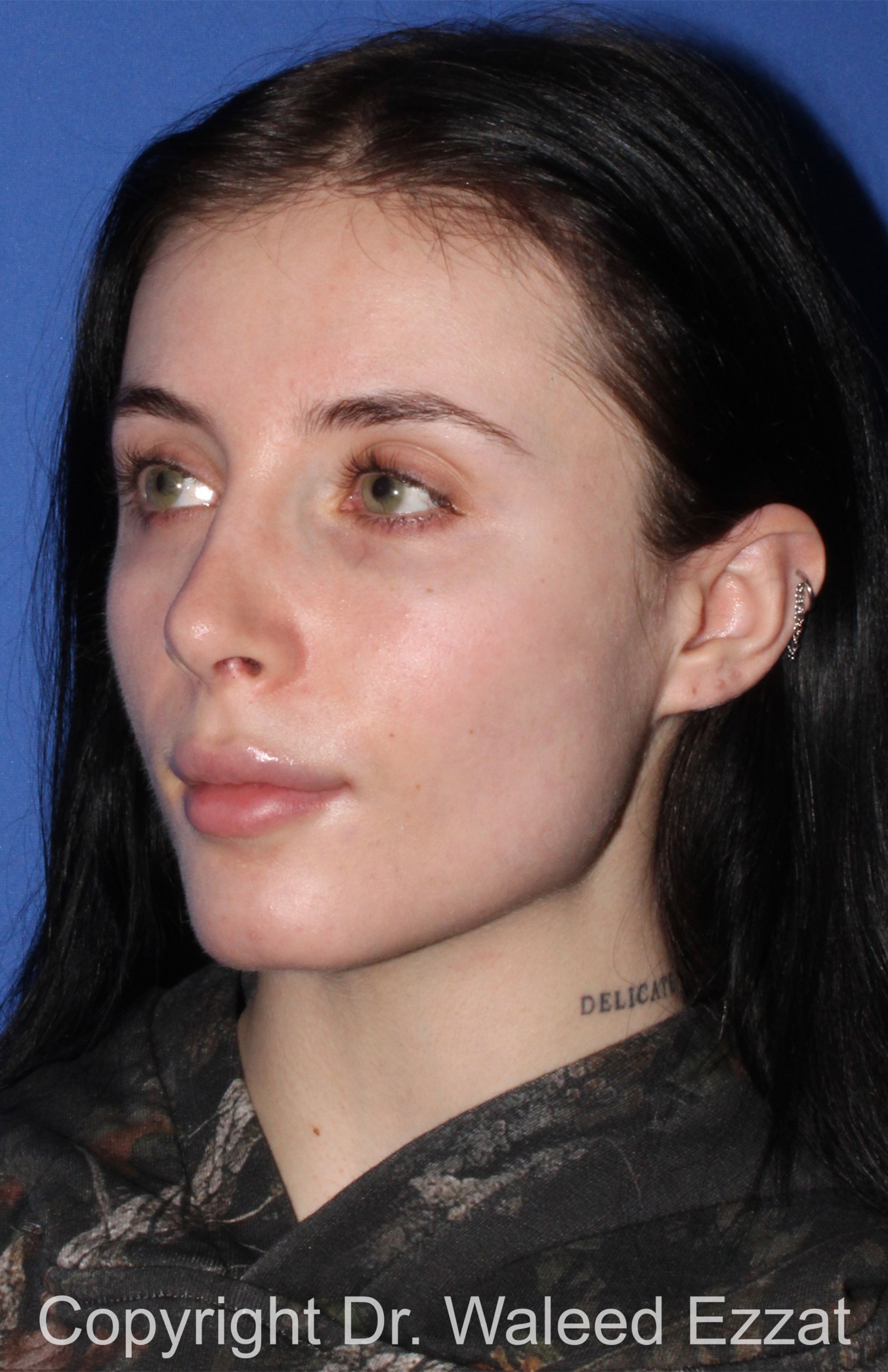 Caucasian/European Rhinoplasty Patient Photo - Case 347 - after view-1