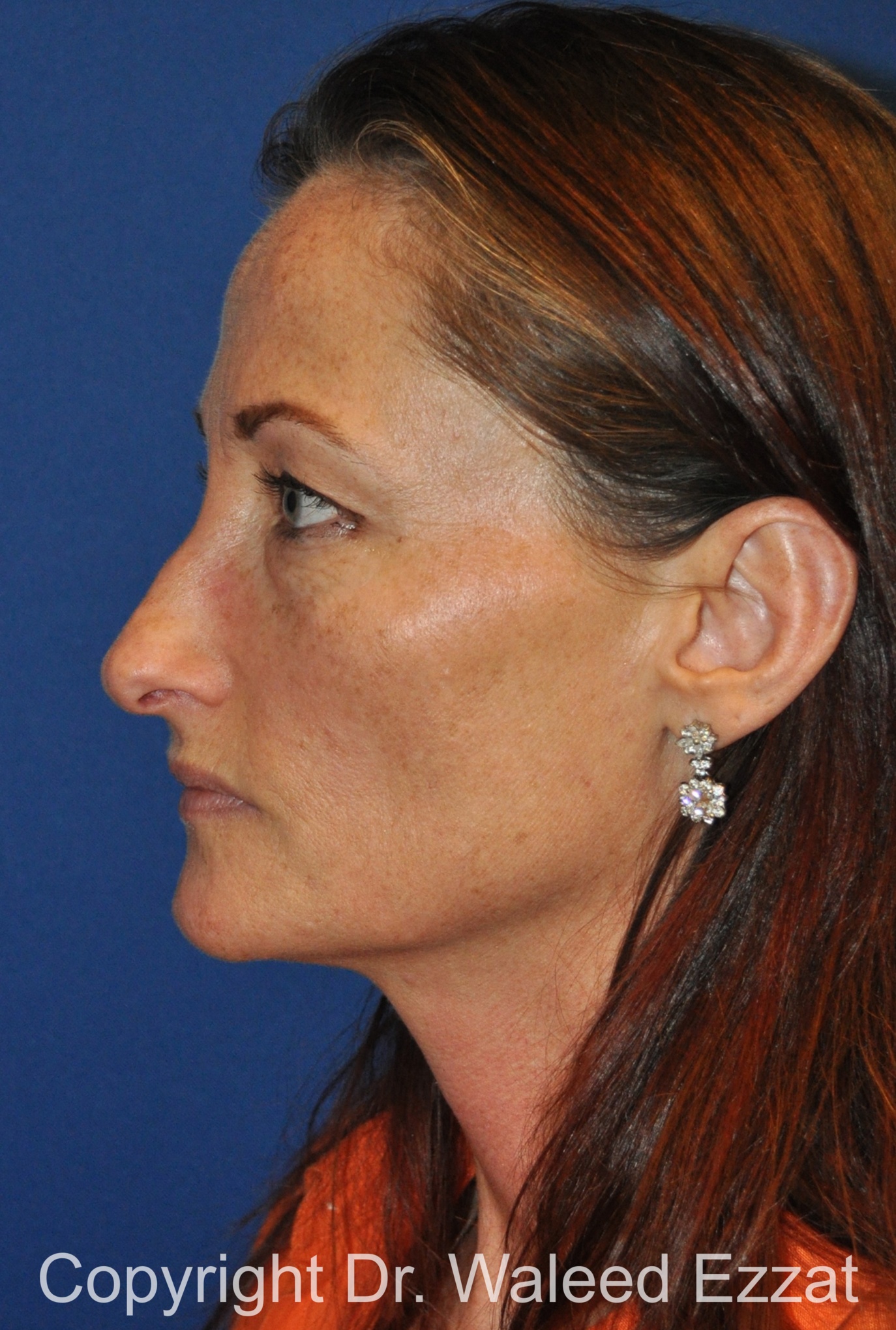 Caucasian/European Rhinoplasty Patient Photo - Case 348 - before view-2