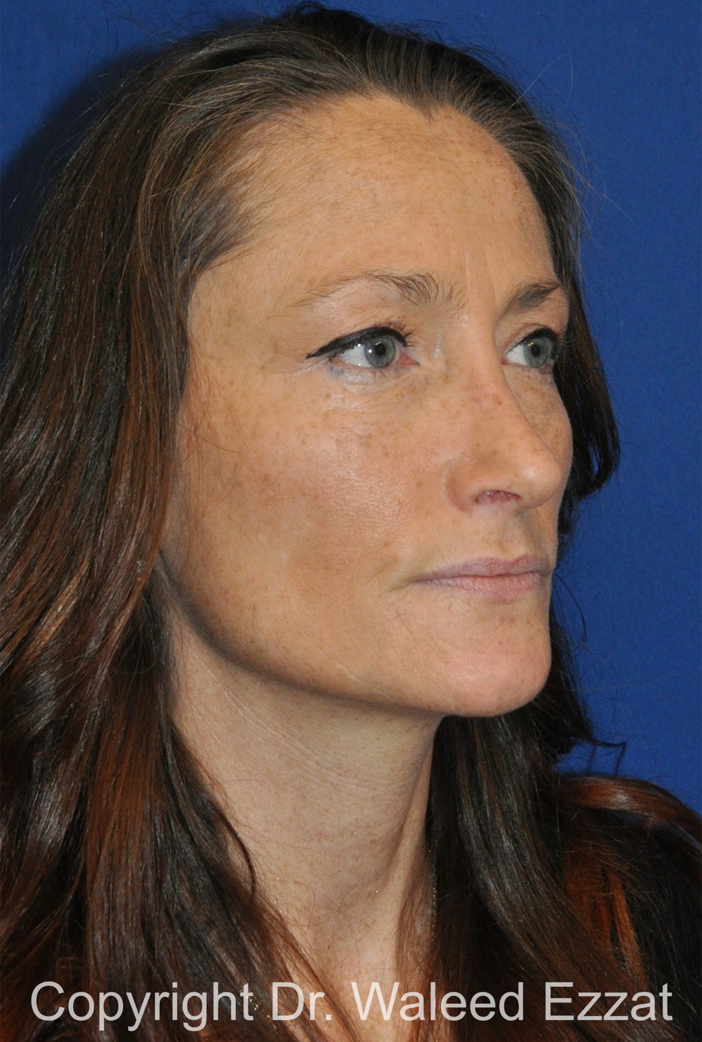 Caucasian/European Rhinoplasty Patient Photo - Case 348 - after view-1