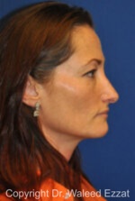 Caucasian/European Rhinoplasty - Case 348 - Before