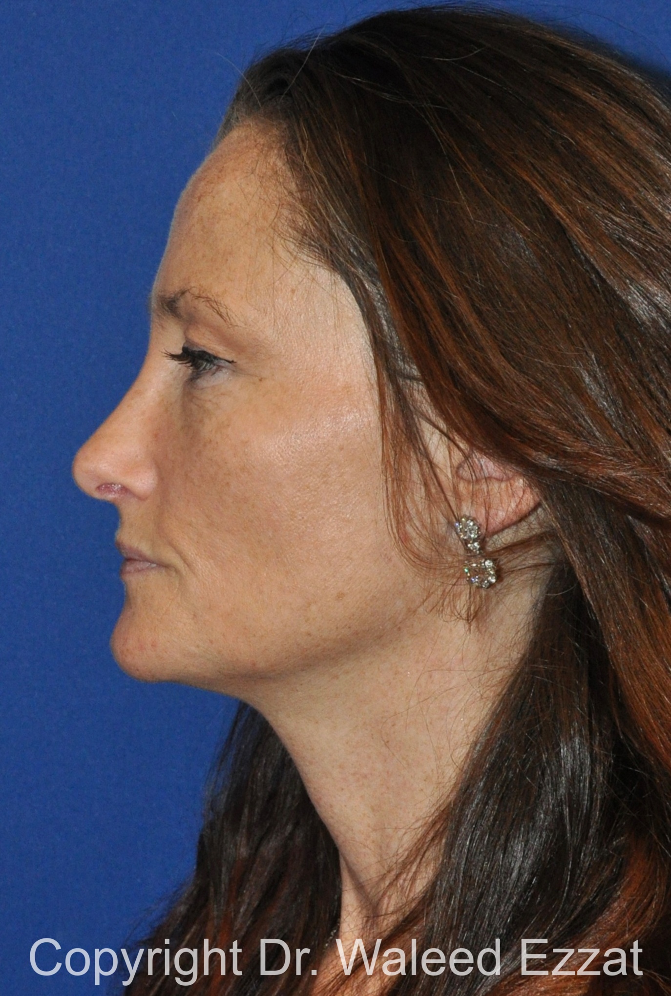 Caucasian/European Rhinoplasty Patient Photo - Case 348 - after view-2