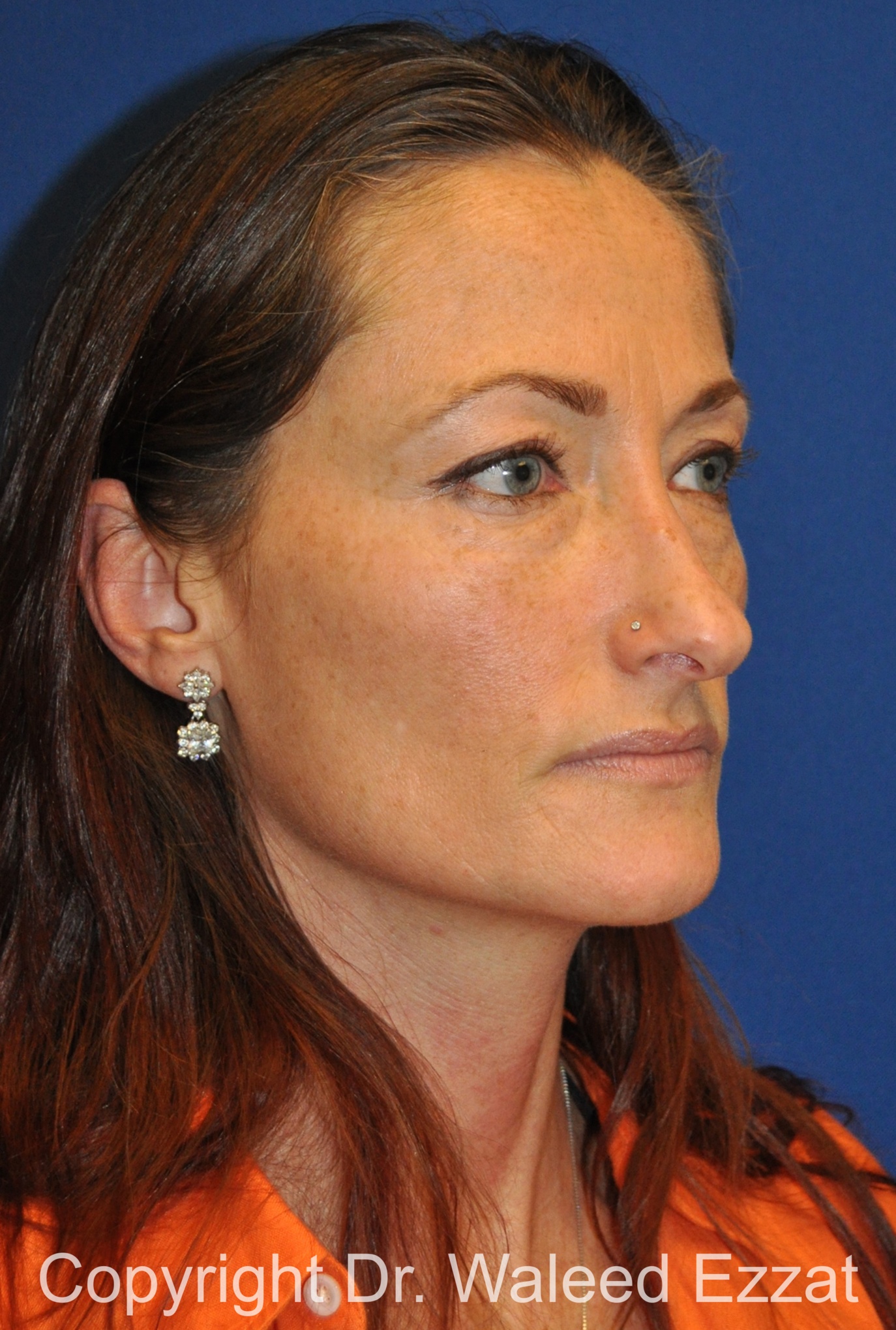 Caucasian/European Rhinoplasty Patient Photo - Case 348 - before view-1