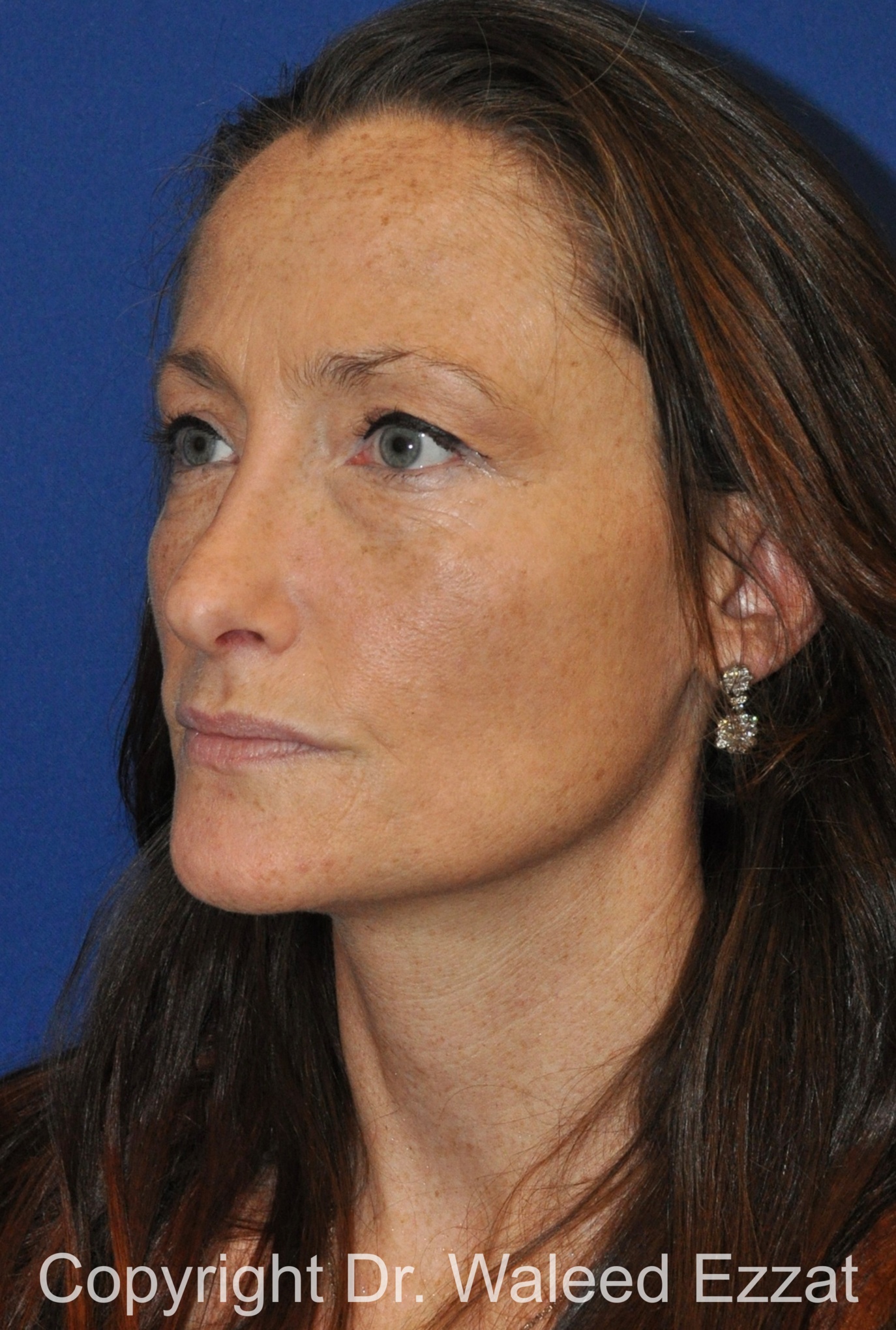 Caucasian/European Rhinoplasty Patient Photo - Case 348 - after view-3