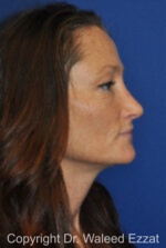 Caucasian/European Rhinoplasty - Case 348 - After