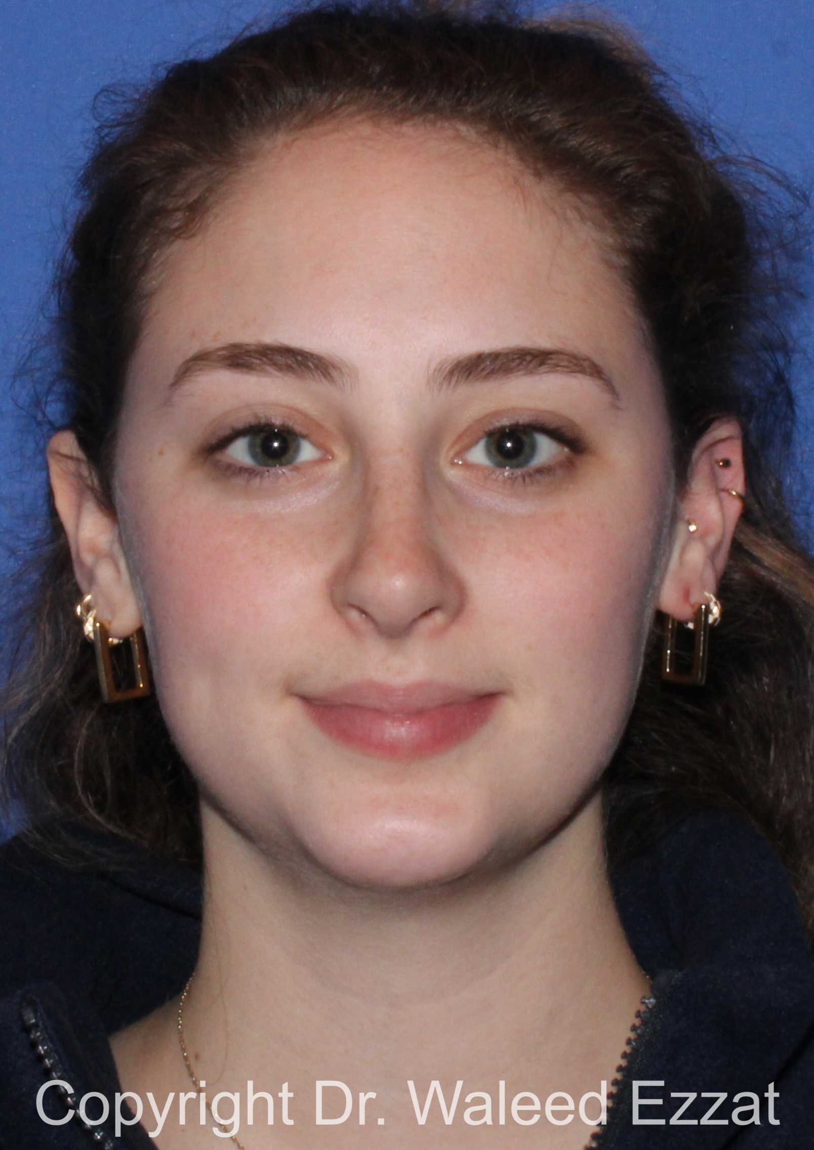 Caucasian/European Rhinoplasty Patient Photo - Case 350 - after view-2